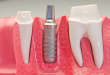 Dental Implant Model without Crown